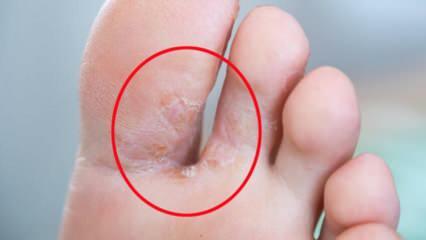 Co je houba nohou? Jaké jsou příznaky plísní? Existuje lék na nohu sportovce?