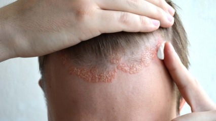 Jaké jsou příznaky seboroické dermatitidy a kdo se projevuje? Potraviny, které vyvolávají nemoc
