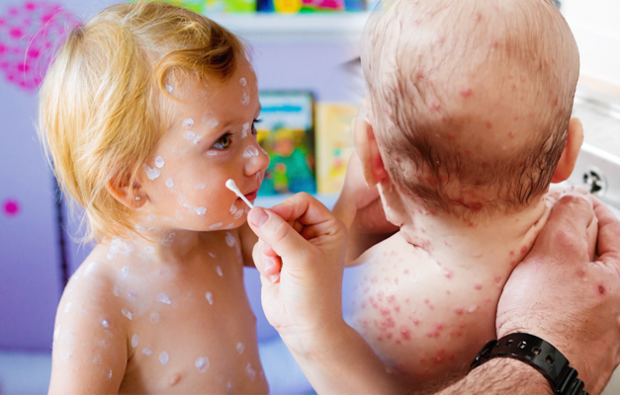 Příznaky planých neštovic v dětství a dětství