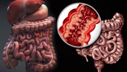 Co je Crohnova nemoc? Jaké jsou příznaky Crohnovy choroby? Existuje lék na Crohna?