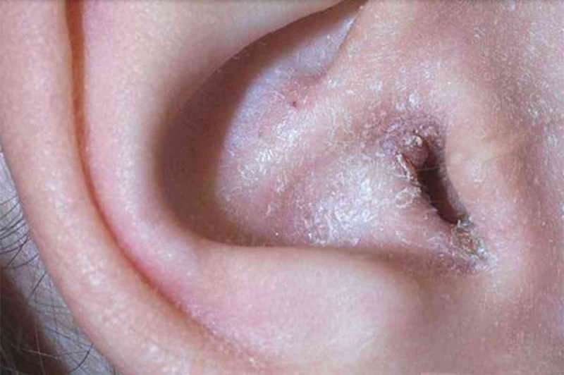 Co způsobuje loupání za uchem a jak to projde? Definitivní řešení pro ekzém za uchem ...