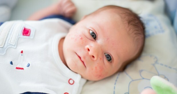 Jak akné přechází na dětskou tvář? Metody sušení akné (Milia)