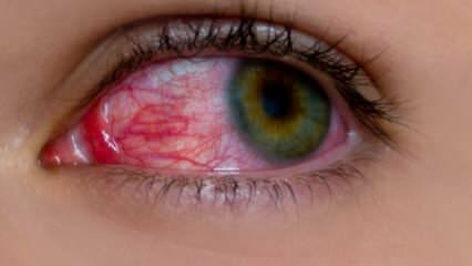 Co způsobuje alergii na oči? Jaké jsou příznaky oční alergie? Co je dobré pro oční alergie? 