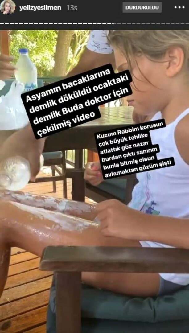 Noha dcery Yeliz Yeşilmen byla nalita vroucí vodou