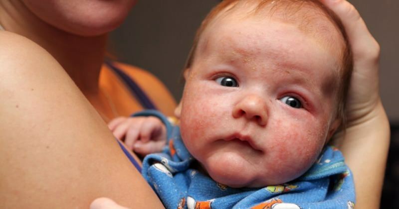 Příčiny zarudnutí očí u kojenců