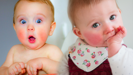 Pozornost u dětí s červenými tvářemi! Syndrom slapané tváře a jeho příznaky