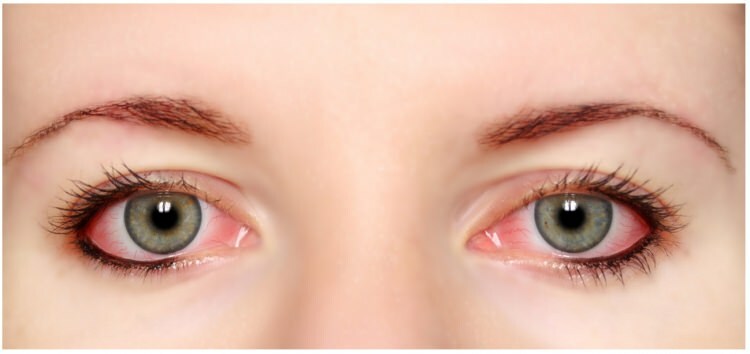 Má alergie na řasenku a oční linky v očích?