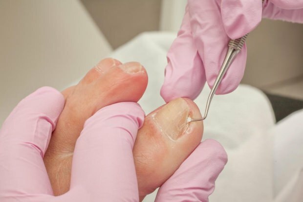 Co způsobuje zarůstání nehtů na nohou a jaké jsou příznaky? Přírodní způsoby, které jsou dobré pro zarůstání nehtů ...
