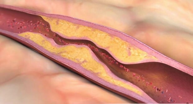 Co způsobuje aterosklerózu? Kolik typů vaskulární okluze existuje?