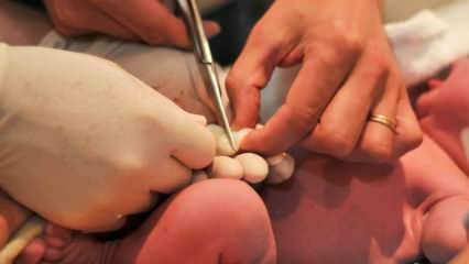 Kdy je pupeční šňůra u kojenců přerušena? Výhody pozdního přerušení pupečníku