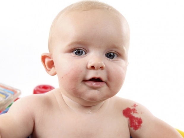 příčiny mateřské značky u kojenců