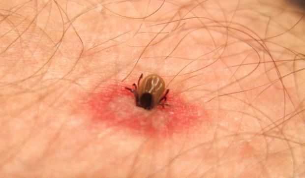Jaké je kousnutí hmyzem? Příznaky kousnutí hmyzem! Přirozená metoda pro uhryznutí komáry