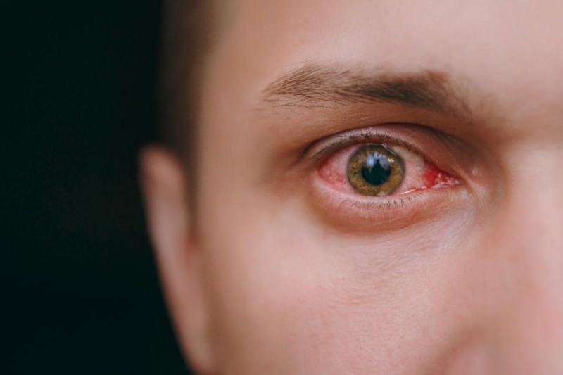 zalévání očí, krvácení a svědění příznaky koronaviry