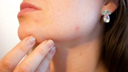 Co je rakovina kůže (melanom)? Jaké jsou příznaky melanomu a existuje léčba?