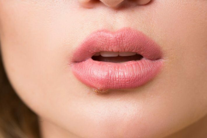 Co je to rakovina jazyka? Jaké jsou příznaky?