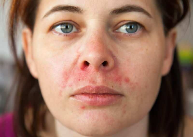 Proč se kolem rtu objevuje akné? Jak se léčí periorální dermatitida?