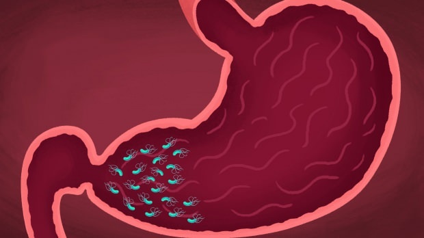 některé viry a bakterie mohou způsobit gastritidu
