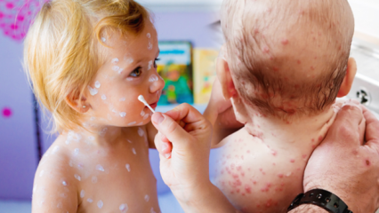 Jak pochopit plané neštovice v kojeneckém a dětském věku? Příznaky a léčba neštovic