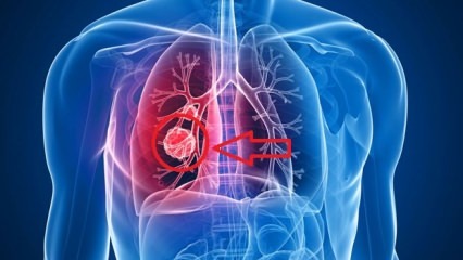 Příznaky rakoviny plic: stádia rakoviny plic!