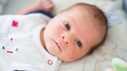 Jak probíhají pupínky na tváři dítěte? Metody sušení akné (Milia)