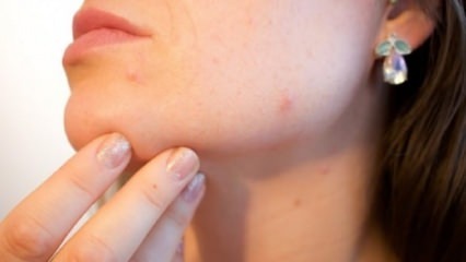 Přírodní lék na akné na bradě