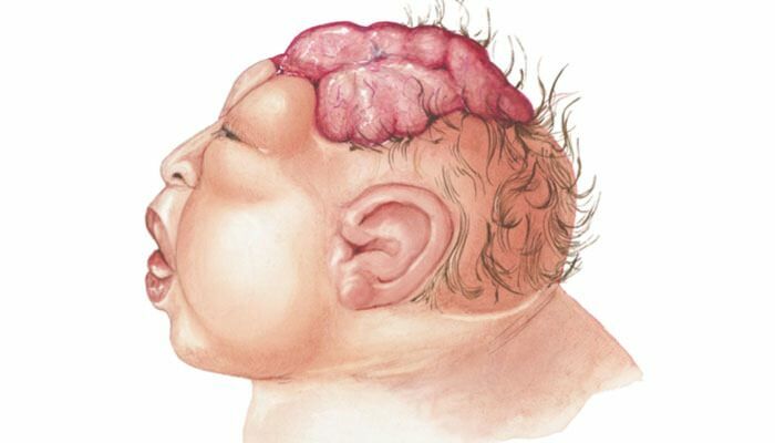 Co je Anencephaly? Jaké jsou příznaky anencefalie u kojenců a dětí? Anencefálie způsobuje ...
