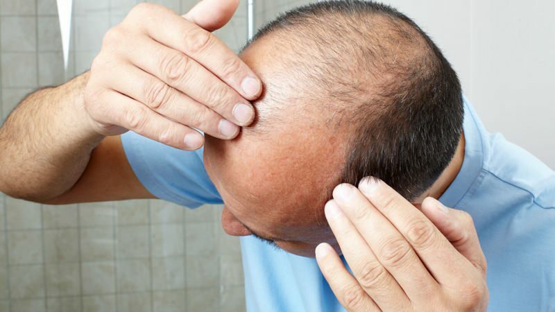 Zabraňuje transplantace vlasů ghusl?