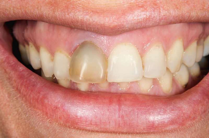 ztmavnutí zubů se někdy může soustředit na jeden zub