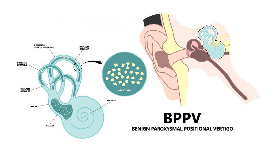 Proč se hlava točí při ležení? Co je dobré pro benigní paroxysmální polohové vertigo? Jak se zbavit BPPV