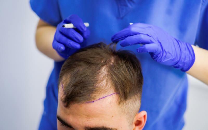 Je přípustné transplantovat vlasy při léčbě vypadávání vlasů? Co jsou protetické vlasy? Překáží protetické vlasy Ghuslovi?