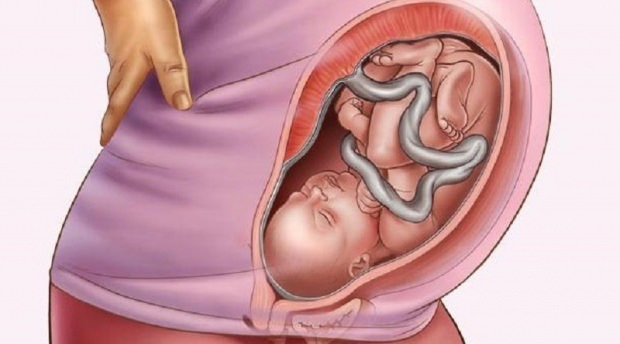 Co je placenta previa?