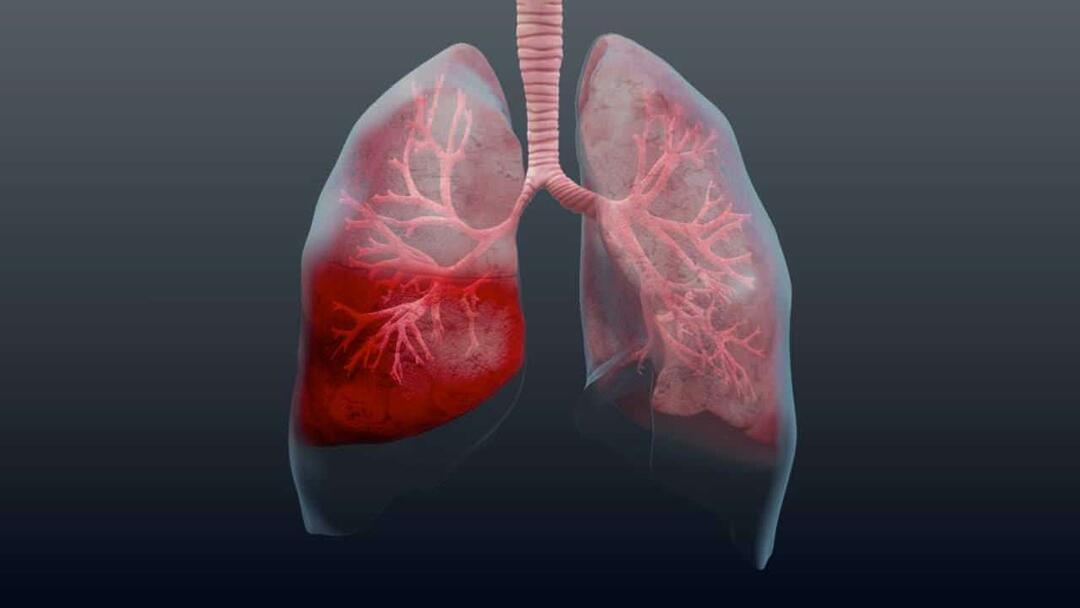 Co je zápal plic a jaké jsou jeho příznaky? Jak se léčí nový epidemický virus pneumonie?