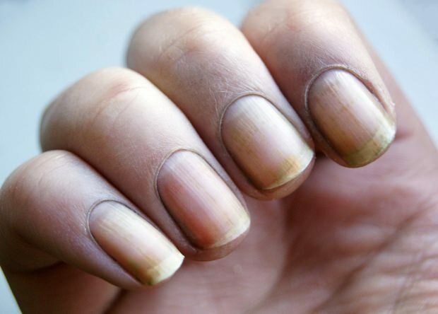 Proč hřebík zžloutne? Jak vybělit nehty, které z laku na nehty zbarvily žlutě?