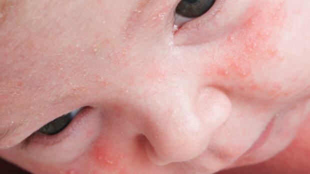 Jak akné procházejí u kojenců?