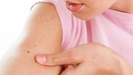 Co je rakovina kůže (kůže) a jaké jsou její příznaky? Způsoby, jak porozumět rakovině kůže