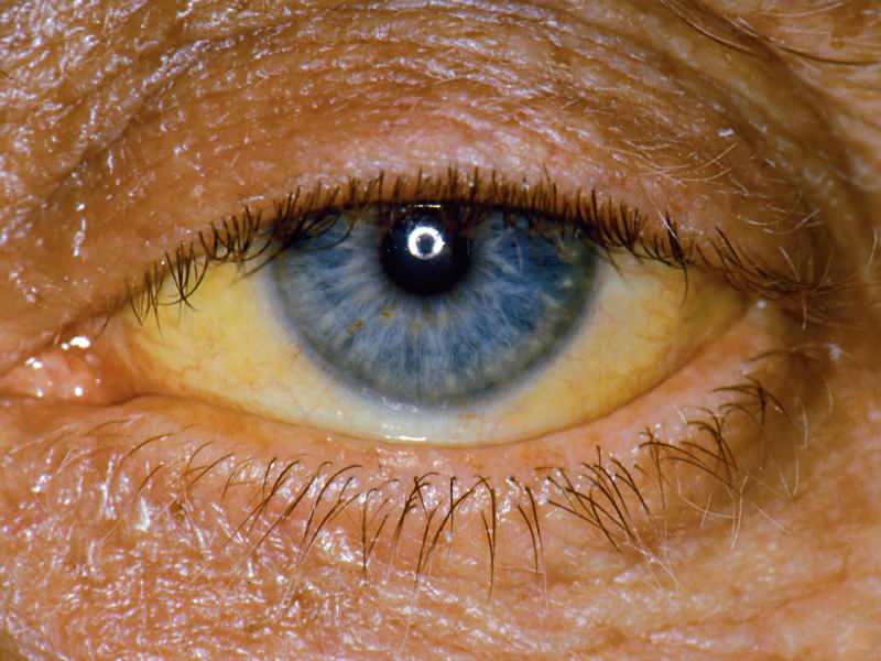 Výška na úrovni bilirubinu způsobuje žluté oči a pokožku