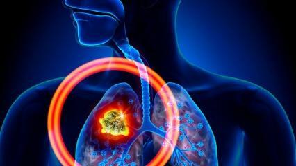 Jaké jsou příznaky rakoviny plic? Existuje léčba rakoviny plic?