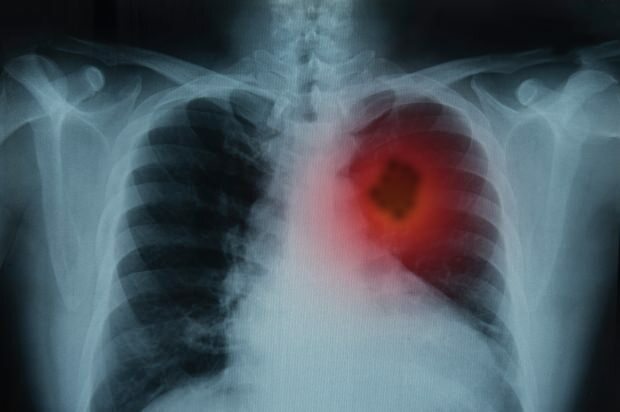 Jaké jsou příznaky rakoviny plic? Existuje léčba rakoviny plic? Chcete-li zabránit rakovině plic ...