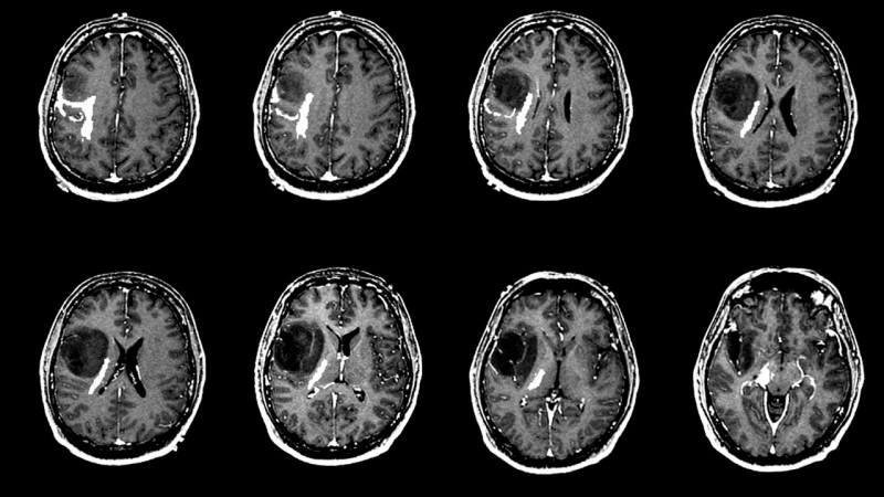 Co způsobuje nádor na mozku? Jaké jsou příznaky nádoru na mozku? Je léčba nádorů na mozku obtížná?