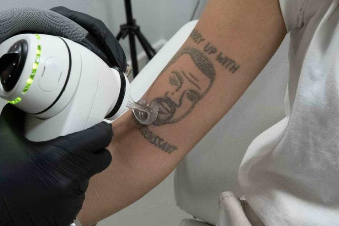 Tetování Kanye Westa bude v Londýně zdarma odstraněno 