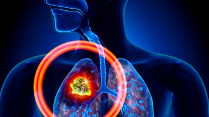 Jaké jsou příznaky rakoviny plic? Existuje léčba rakoviny plic? Chcete-li zabránit rakovině plic ...