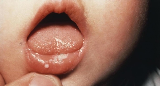 Jak jsou vředy v ústech u dětí