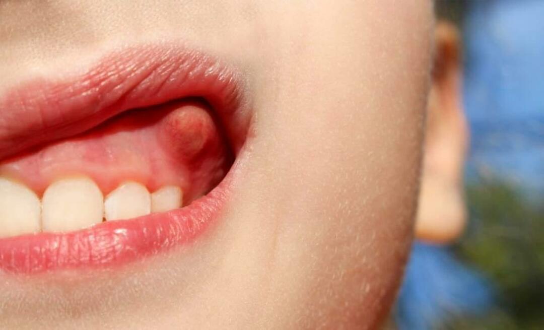 Proč zub abscesuje a jaké jsou příznaky? Zubní absces, jak se léčí?