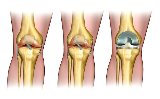Nemoci, jako je artritida, vedou k úlevě od bolesti