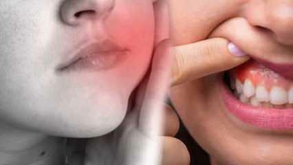 Co způsobuje zubní absces? Jaké jsou příznaky a za kolik dní? Přírodní řešení zubního abscesu...