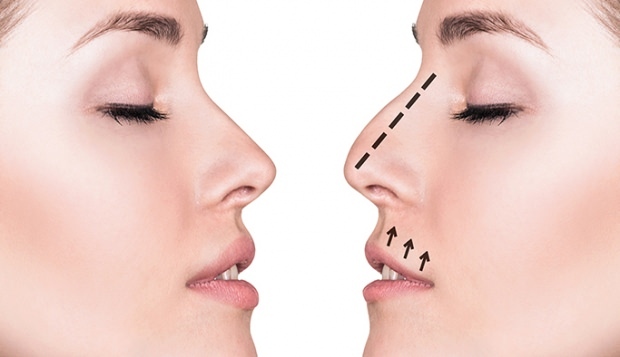 Jak se provádí operace nosu? V jakých případech se provádí operace nosu?