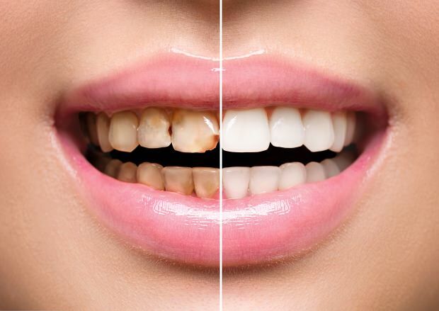 V důsledku nezdravé výživy dochází ke ztrátě zubů i ke ztrátě zubů