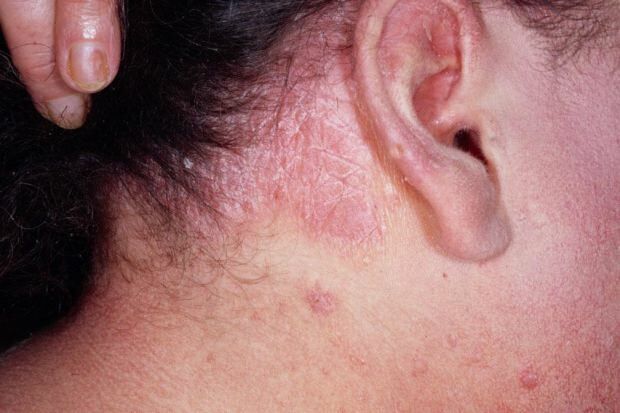 Jaké jsou příznaky seboroické dermatitidy a kdo se projevuje? Potraviny, které vyvolávají nemoc