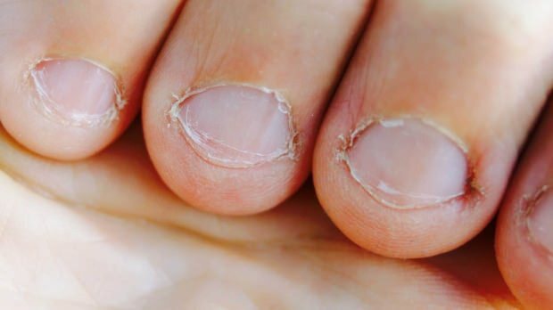 Co je choroba na nehty? Jaké nemoci způsobuje stravování nehtů?