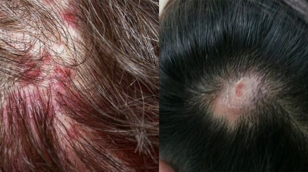 Proč se akné objevuje na pokožce hlavy